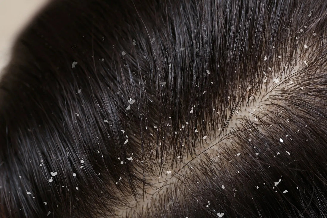 Tea Tree Oil for Dandruff: Does It Really Work?