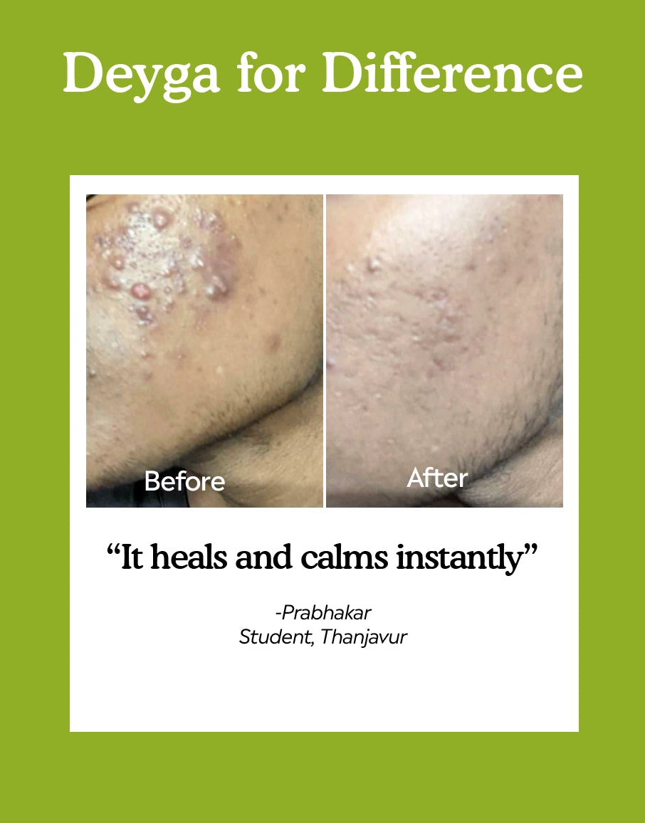 Deyga best aloe vera gel for face - see the difference