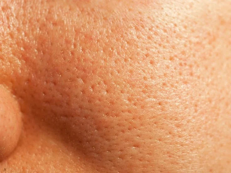Is Salicylic Acid Good For Open Pores