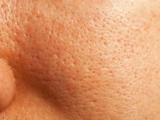 Is Salicylic Acid Good For Open Pores
