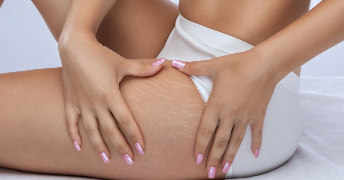 Natural Oils To Treat Stretch Marks Easily
