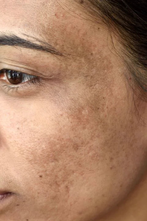 Can Pigmentation Be Removed