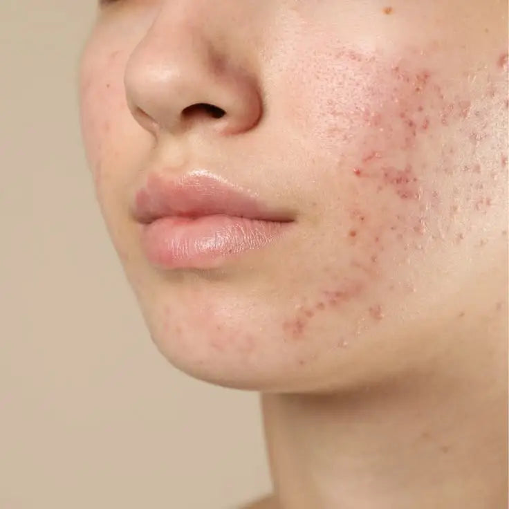 How To Prevent A Pimple From Forming