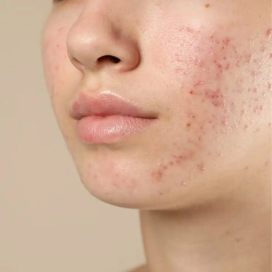 How To Prevent A Pimple From Forming