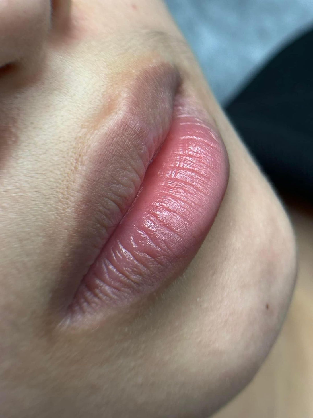 How To Remove Lip Pigmentation