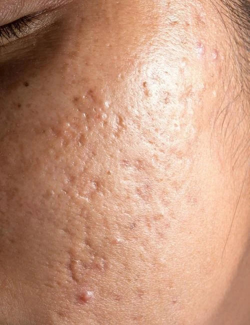 How Long Does It Take For Acne Scars To Fade