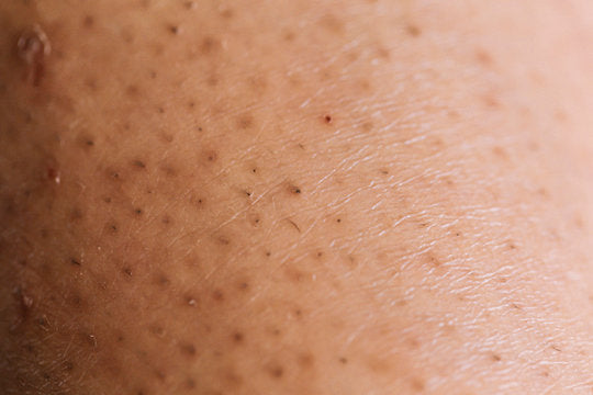Ingrown Hair Will ‘Never’ Leave