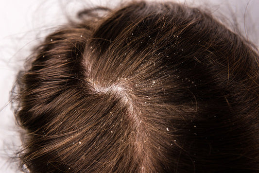 Dandruff - Causes, Treatments, and Products to Cure