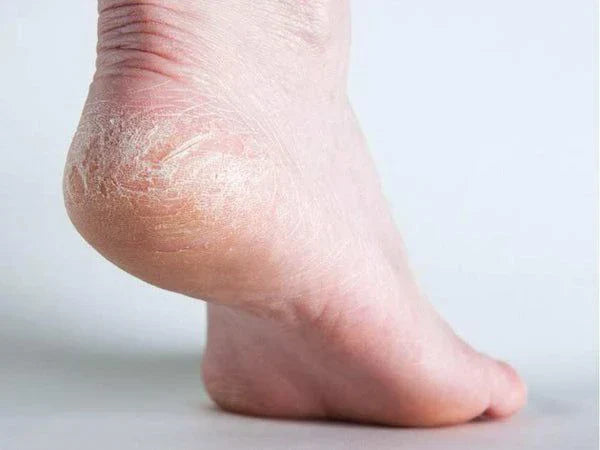 How To Cure Cracked Heels