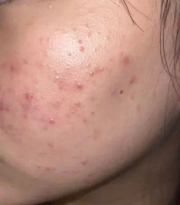 How To Avoid Pimples On Face Naturally