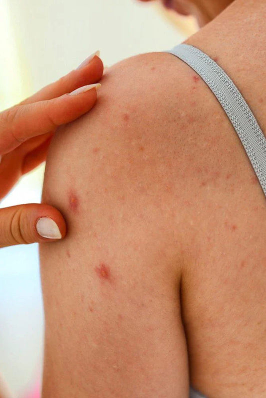 How To Remove Back Acne