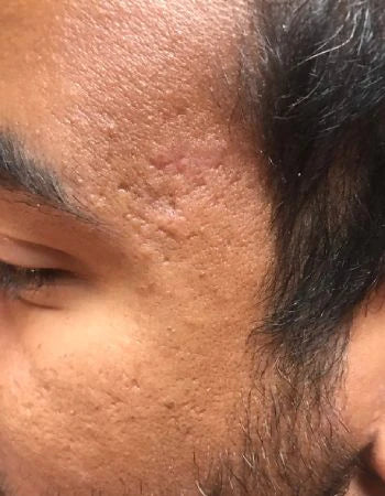 Does Niacinamide Help With Acne Scars