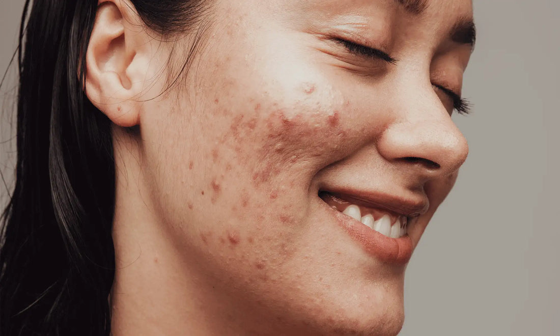 Acne Prone Skin - Everything For You To Know