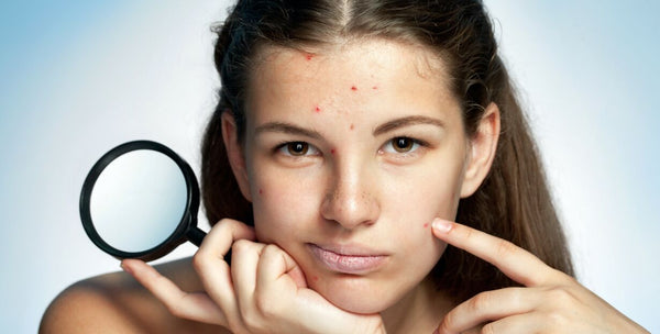 ENSURE PROTECTION AGAINST CYSTIC ACNES!