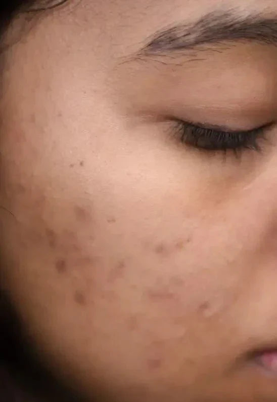 Types Of Acne Scars