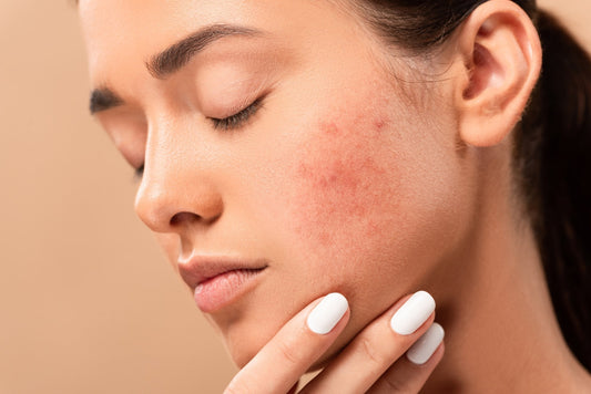 Four-Step skincare routine for acne scars