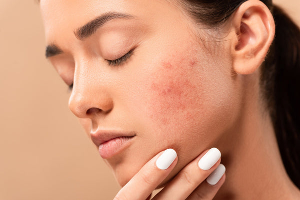 Four-Step Skincare Routine To Bid Goodbye To Acne Scars