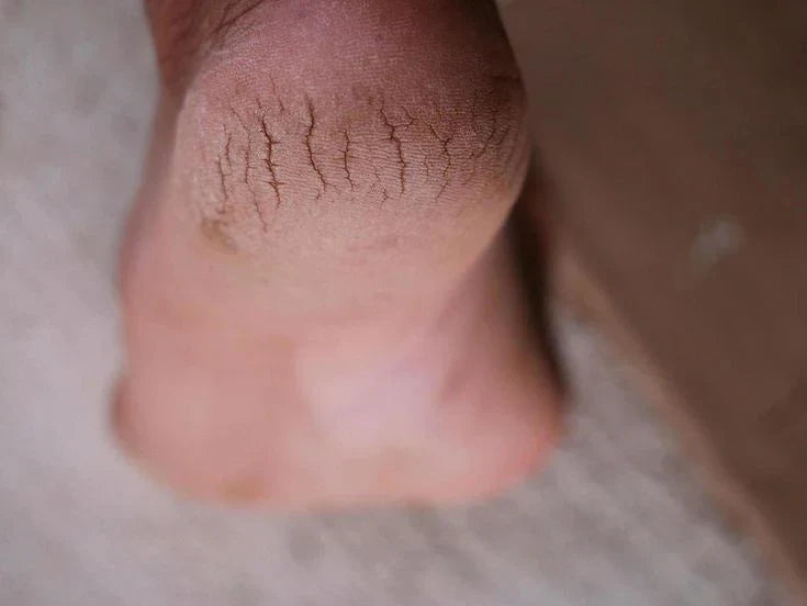 Home Remedies For Cracked Heels