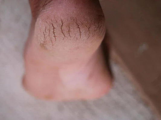 Home Remedies For Cracked Heels