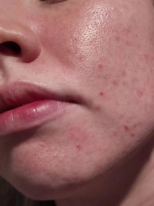How To Remove Blackheads From Cheeks