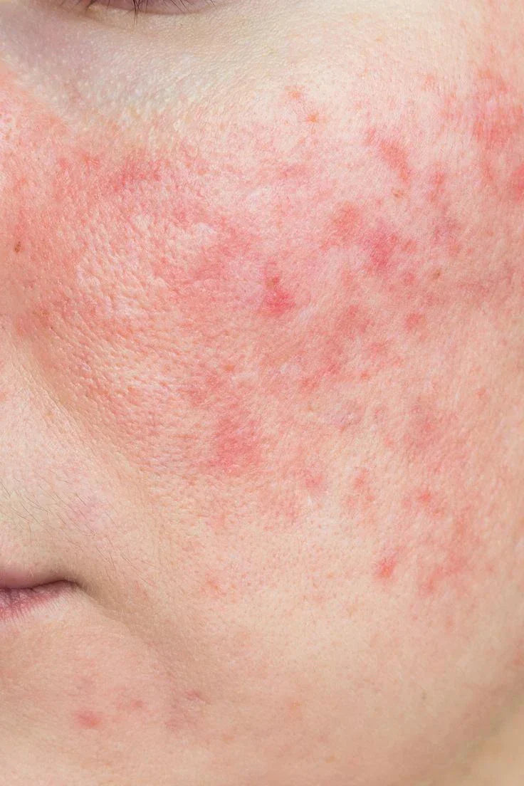 How To Get Rid Of Inflamed Skin On Face