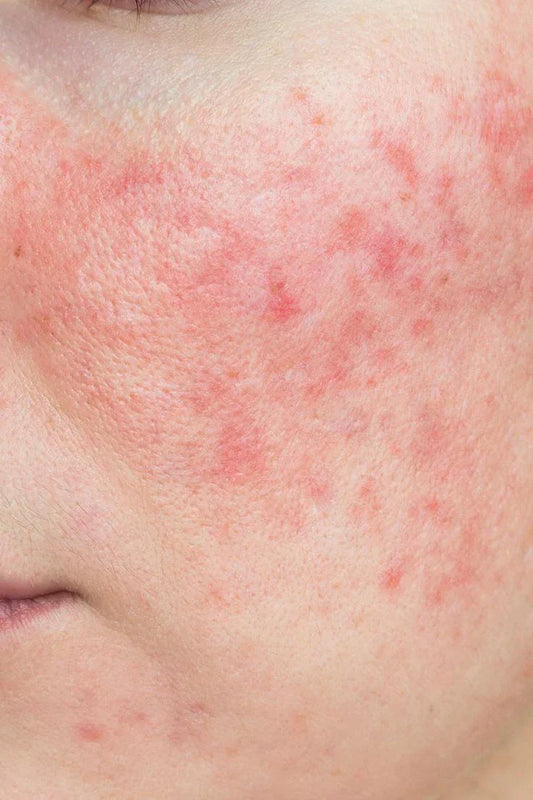 How To Get Rid Of Inflamed Skin On Face