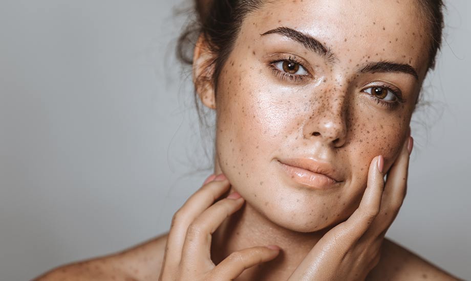 WHAT IS HYPERPIGMENTATION