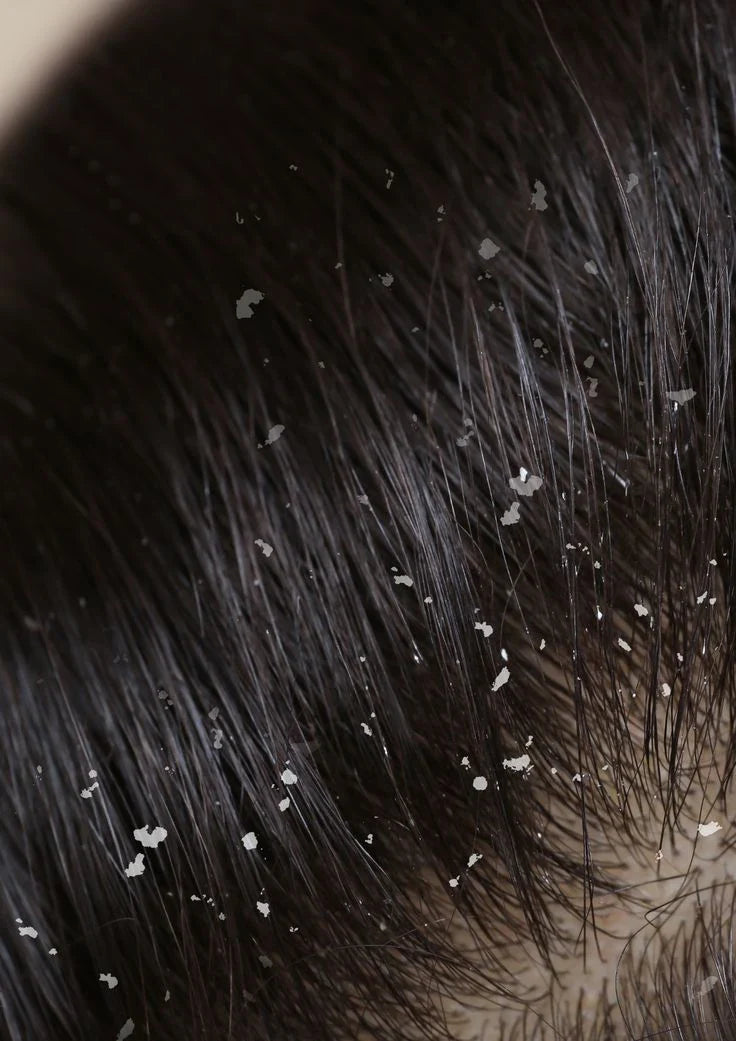 What Causes Dandruff On Scalp