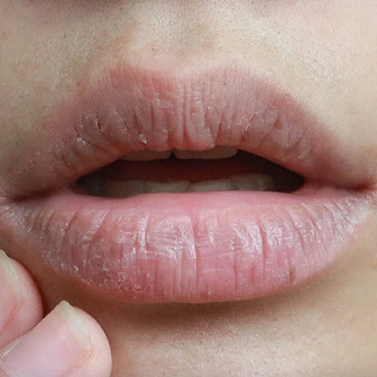 What Is The Reason Of Dry Lips