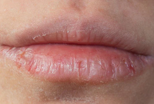How To Treat Dry Lips Naturally