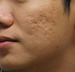 Does Retinol Help With Acne Scars