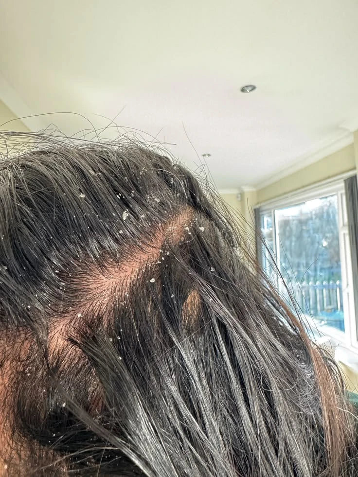 Can Dandruff Cause Hair Fall