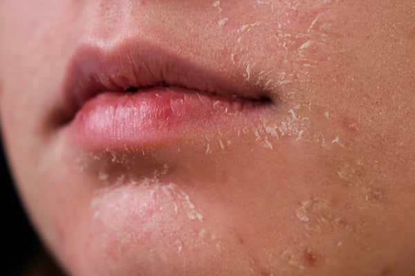 WHAT CAUSES FLAKY SKIN AFTER FACE WASH?