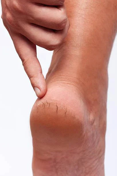 Reason For Cracked Heels