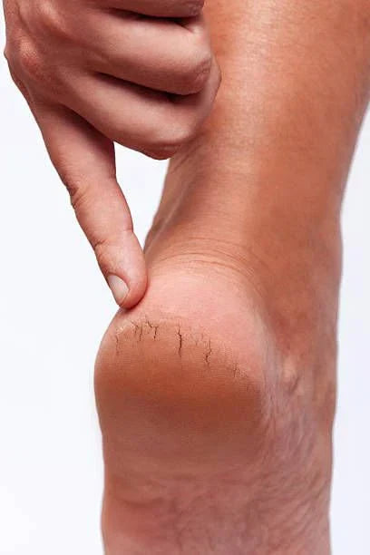 Reason For Cracked Heels