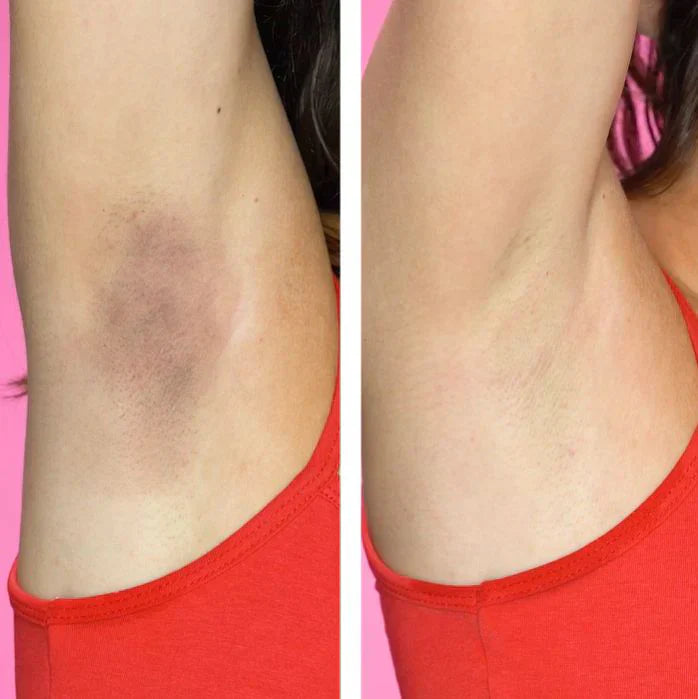 How to Remove Dark Underarms