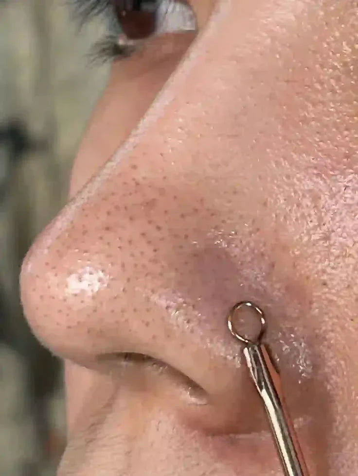 How To Get Rid Of Blackheads Naturally