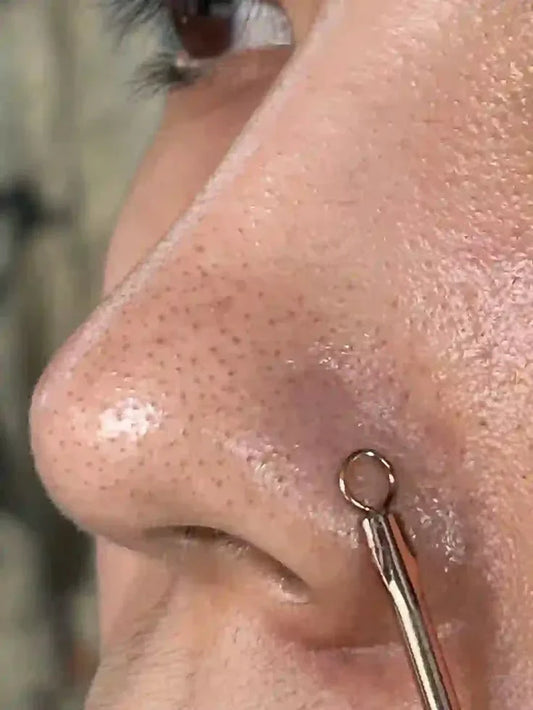 How To Get Rid Of Blackheads Naturally