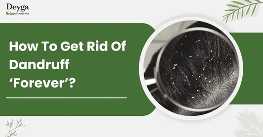 How To Get Rid Of Dandruff ‘Forever’?