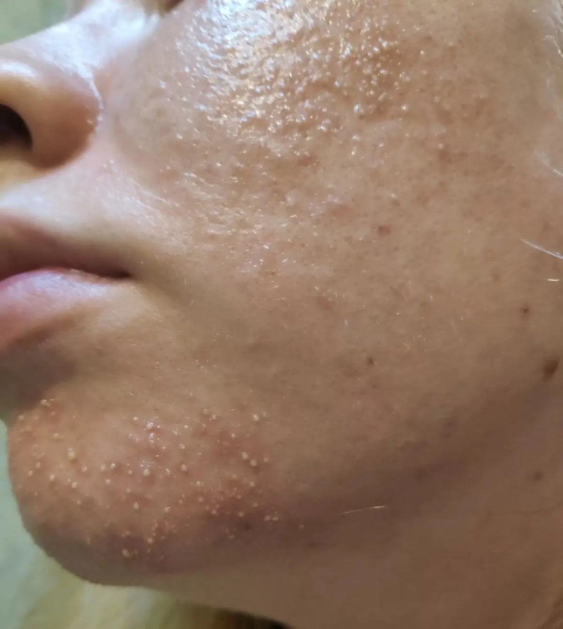 How To Get Rid Of Fungal Acne