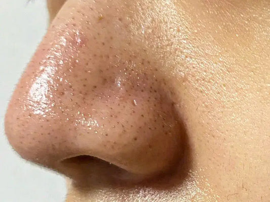 How To Get Rid Of Nose Acne