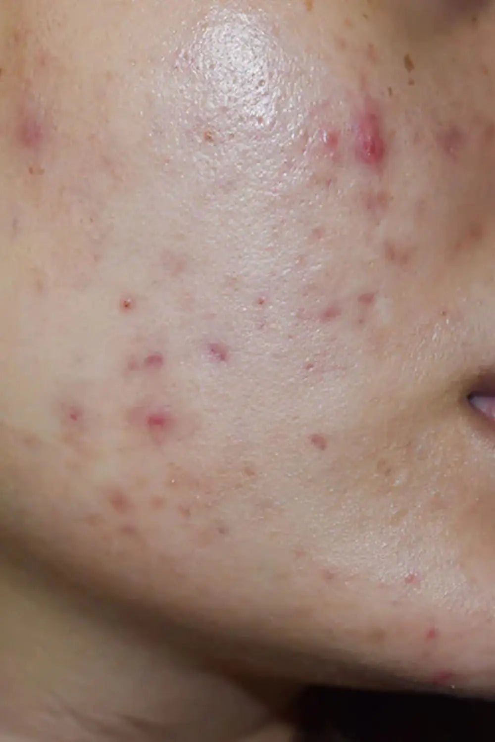 How To Get Rid Of Red Pimples