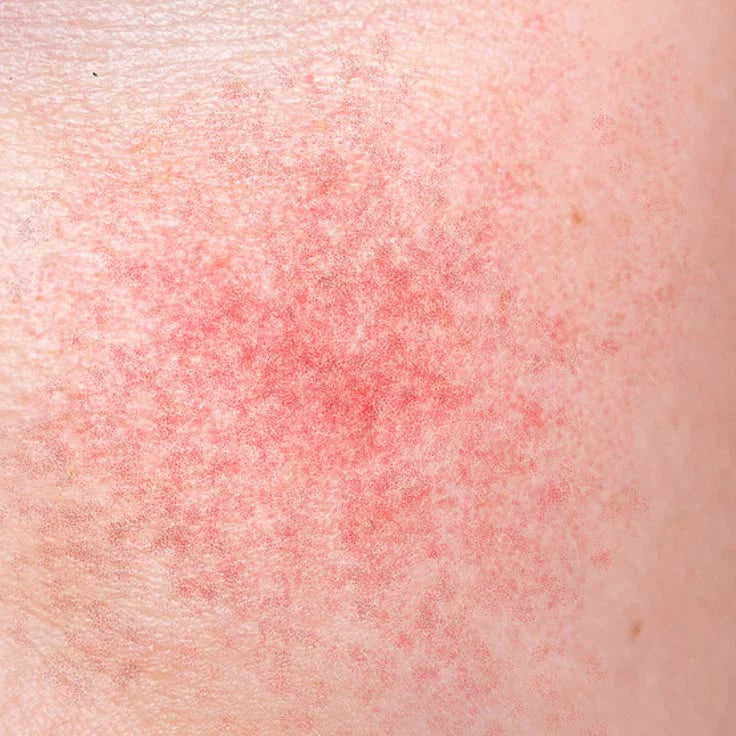 How To Reduce Skin Rashes