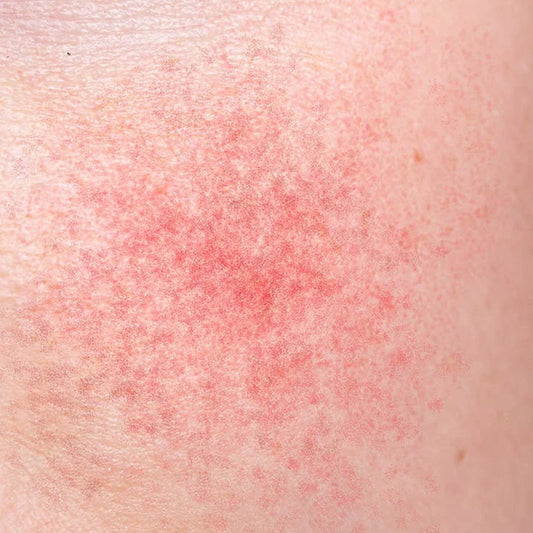 How To Reduce Skin Rashes