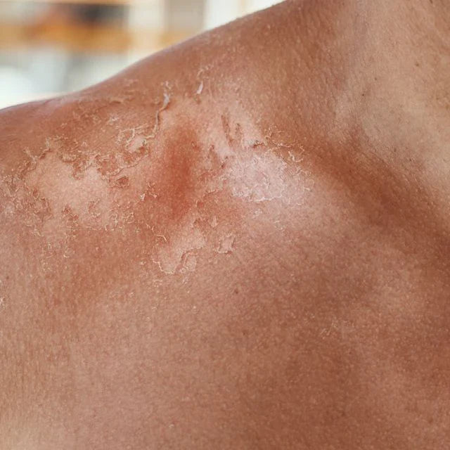 How To Remove Burn Marks From Skin