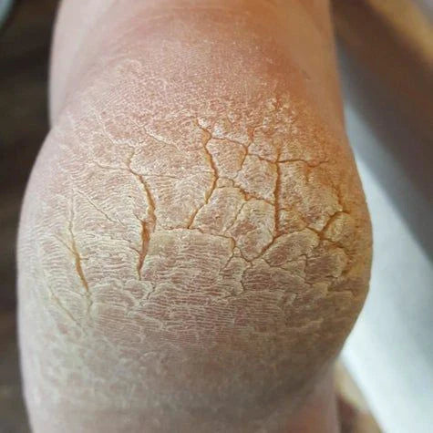 How To Remove Dead Skin From Foot