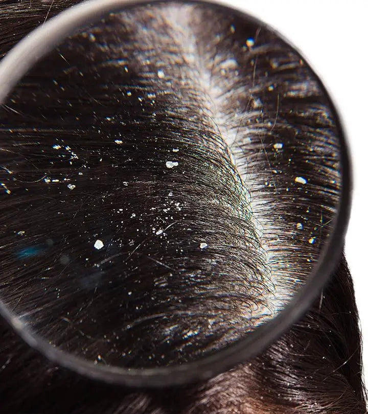 How to Get Rid of Scalp Dandruff