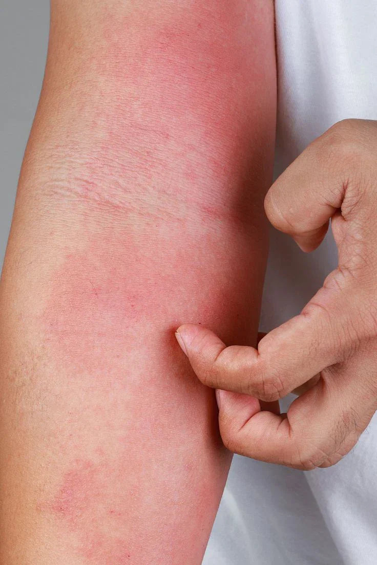 Skin Irritation Causes