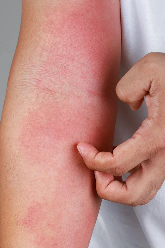 Skin Irritation Causes