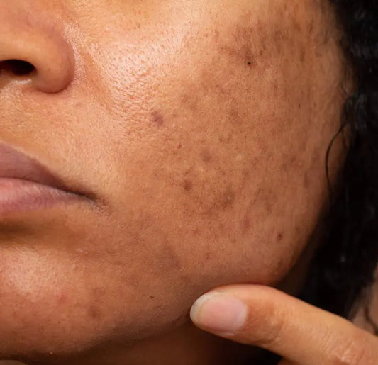 10 Best Pigmentation Cream Recommended By Dermatologist